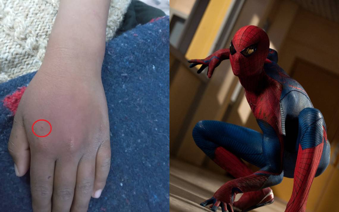 Niño termina en el hospital tras dejarse picar por araña para convertirse  en Spider-Man - El Sol de Puebla | Noticias Locales, Policiacas, sobre  México, Puebla y el Mundo